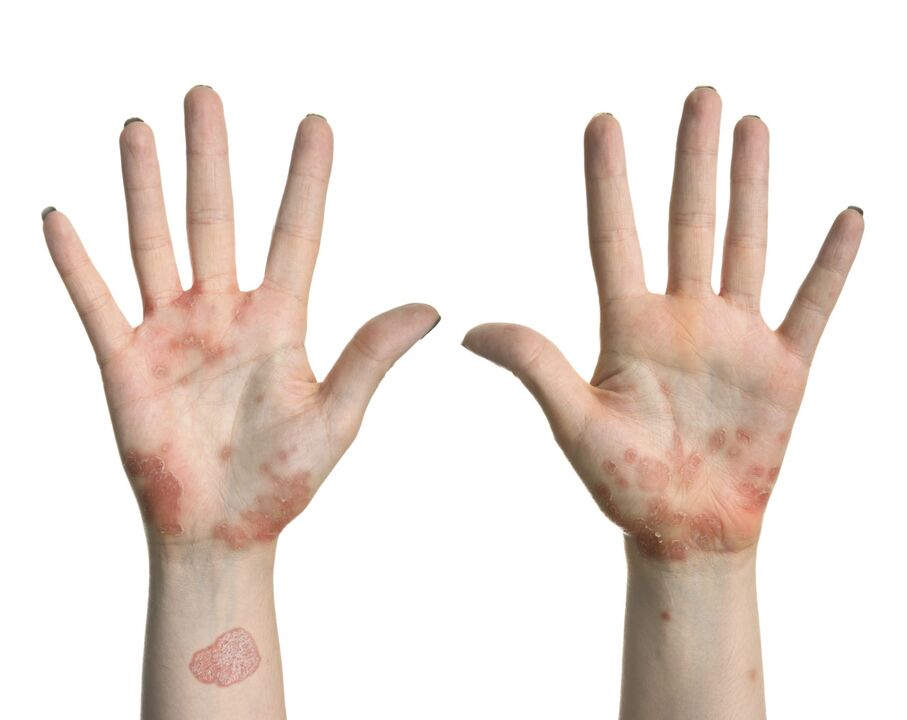 Psoriasis dans les mains